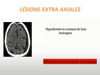 LÉSIONS EXTRA AXIALES
 