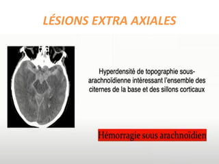 LÉSIONS EXTRA AXIALES
 