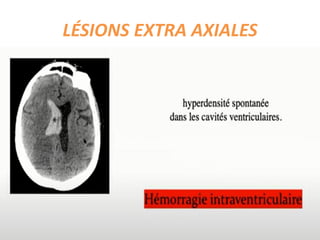 LÉSIONS EXTRA AXIALES
 