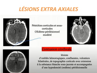 LÉSIONS EXTRA AXIALES
 