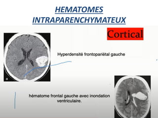 HEMATOMES
INTRAPARENCHYMATEUX
 