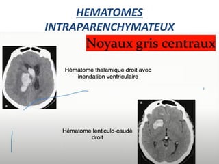 HEMATOMES
INTRAPARENCHYMATEUX
 