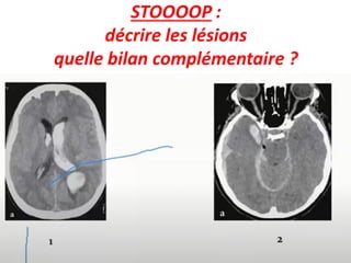STOOOOP :
décrire les lésions
quelle bilan complémentaire ?
 