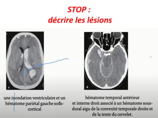 STOP :
décrire les lésions
 