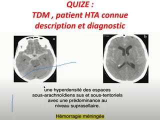 QUIZE :
TDM , patient HTA connue
description et diagnostic
 