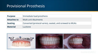 Provisional Prosthesis
Purpose Immediate load prosthesis
Attaches to Multi-unit Abutments
Seating Converted (protocol varies), seated, and screwed to MUAs
Material Lucitone
 