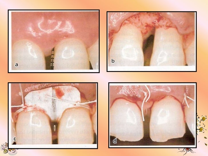 Guided tissue regeneration