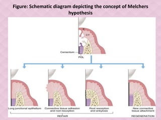 Figure: Schematic diagram depicting the concept of Melchers
hypothesis
 