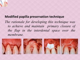 Modified papilla preservation technique
The rationale for developing this technique was
to achieve and maintain primary closure of
the flap in the interdental space over the
membrane.
 