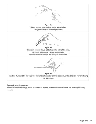 Page 323
/ 394
Figures 3 : Wound debridement
This should be done sparingly, limited to excision of severely contused or lacerated tissue that is clearly becoming
necrotic.
Figure 2a
Always mount a surgical blade using a needle holder.
Change the blade for each new procedure.
Figure 2b
Dissecting forceps should not be held in the palm of the hand,
but rather between the thumb and index finger.
Toothed dissecting forceps should only be used on skin.
Figure 2c
Insert the thumb and the ring finger into the handle of a needle holder (or scissors), and stabilize the instrument using
the index finger.
 