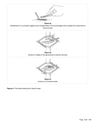 Page 324
/ 394
Figures 4 : Practising making knots using forceps
Figure 3a
Debridement of a contused, ragged wound: straightening of the wound edges with a scalpel. Be conservative in
facial wounds.
Figure 3b
Excision of edges of the aponeurosis to prevent necrosis.
Figure 3c
Excision of contused muscle.
 