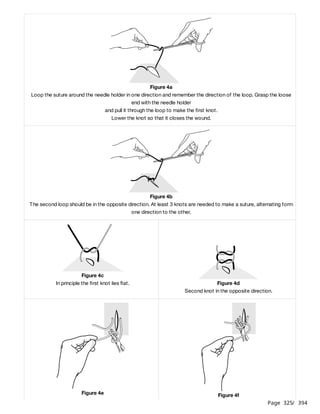 Page 325
/ 394
Figure 4a
Loop the suture around the needle holder in one direction and remember the direction of the loop. Grasp the loose
end with the needle holder
and pull it through the loop to make the first knot.
Lower the knot so that it closes the wound.
Figure 4b
The second loop should be in the opposite direction. At least 3 knots are needed to make a suture, alternating form
one direction to the other.
Figure 4c
In principle the first knot lies flat. Figure 4d
Second knot in the opposite direction.
Figure 4e Figure 4f
 