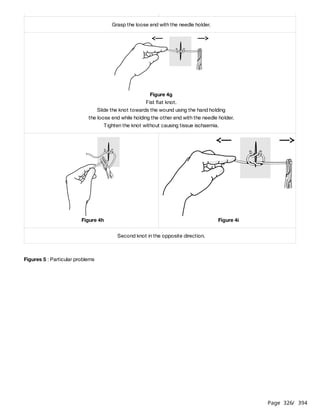 Page 326
/ 394
Figures 5 : Particular problems
Grasp the loose end with the needle holder.
Figure 4g
Fist flat knot.
Slide the knot towards the wound using the hand holding
the loose end while holding the other end with the needle holder.
Tighten the knot without causing tissue ischaemia.
Figure 4h Figure 4i
Second knot in the opposite direction.
 