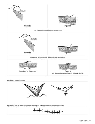 Page 327
/ 394
Figure 6 : Closing a corner
Figure 7 : Closure of the skin, simple interrupted sutures with non-absorbable sutures
Figure 5a Figure 5b
The suture should be as deep as it is wide.
Figure 5c Figure 5d
The suture is too shallow, the edges are invaginated.
Figure 5e
Poor lining of the edges. Figure 5f
Do not make the knot directly over the wound.
​
 