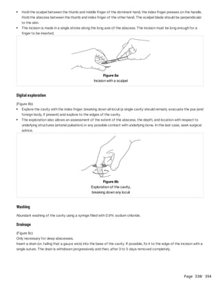 Page 338
/ 394
Digital exploration
(Figure 8b)
Washing
Abundant washing of the cavity using a syringe filled with 0.9% sodium chloride.
Drainage
(Figure 8c)
Only necessary for deep abscesses.
Insert a drain (or, failing that a gauze wick) into the base of the cavity. If possible, fix it to the edge of the incision with a
single suture. The drain is withdrawn progressively and then, after 3 to 5 days removed completely.
Hold the scalpel between the thumb and middle finger of the dominant hand, the index finger presses on the handle.
Hold the abscess between the thumb and index finger of the other hand. The scalpel blade should be perpendicular
to the skin.
The incision is made in a single stroke along the long axis of the abscess. The incision must be long enough for a
finger to be inserted.
​
Figure 8a
Incision with a scalpel
Explore the cavity with the index finger, breaking down all loculi (a single cavity should remain), evacuate the pus (and
foreign body, if present) and explore to the edges of the cavity.
The exploration also allows an assessment of the extent of the abscess, the depth, and location with respect to
underlying structures (arterial pulsation) or any possible contact with underlying bone. In this last case, seek surgical
advice.
​
​
Figure 8b
Exploration of the cavity,
breaking down any loculi
 