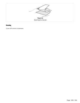 Page 339
/ 394
Dressing
Cover with sterile compresses.
Figure 8c
Drain fixed to the skin
 