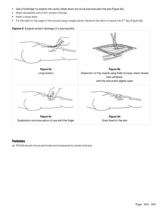 Page 341
/ 394
Figures 9: Surgical incision-drainage of a pyomyositis
Use a forefinger to explore the cavity, break down any loculi and evacuate the pus (Figure 9c).
Wash abundantly with 0.9% sodium chloride.
Insert a large drain.
Fix the drain to the edge of the wound using a single suture. Remove the drain on about the 5 day (Figure 9d).
th
​
Figure 9a
Long incision
Figure 9b
Dissection of the muscle using Kelly forceps, insert closed
then withdraw
with the instrument slightly open
​
Figure 9c
Exploration and evacuation of pus with the finger
Figure 9d
Drain fixed to the skin
Footnotes
(a) POCUS should only be performed and interpreted by trained clinicians.
 