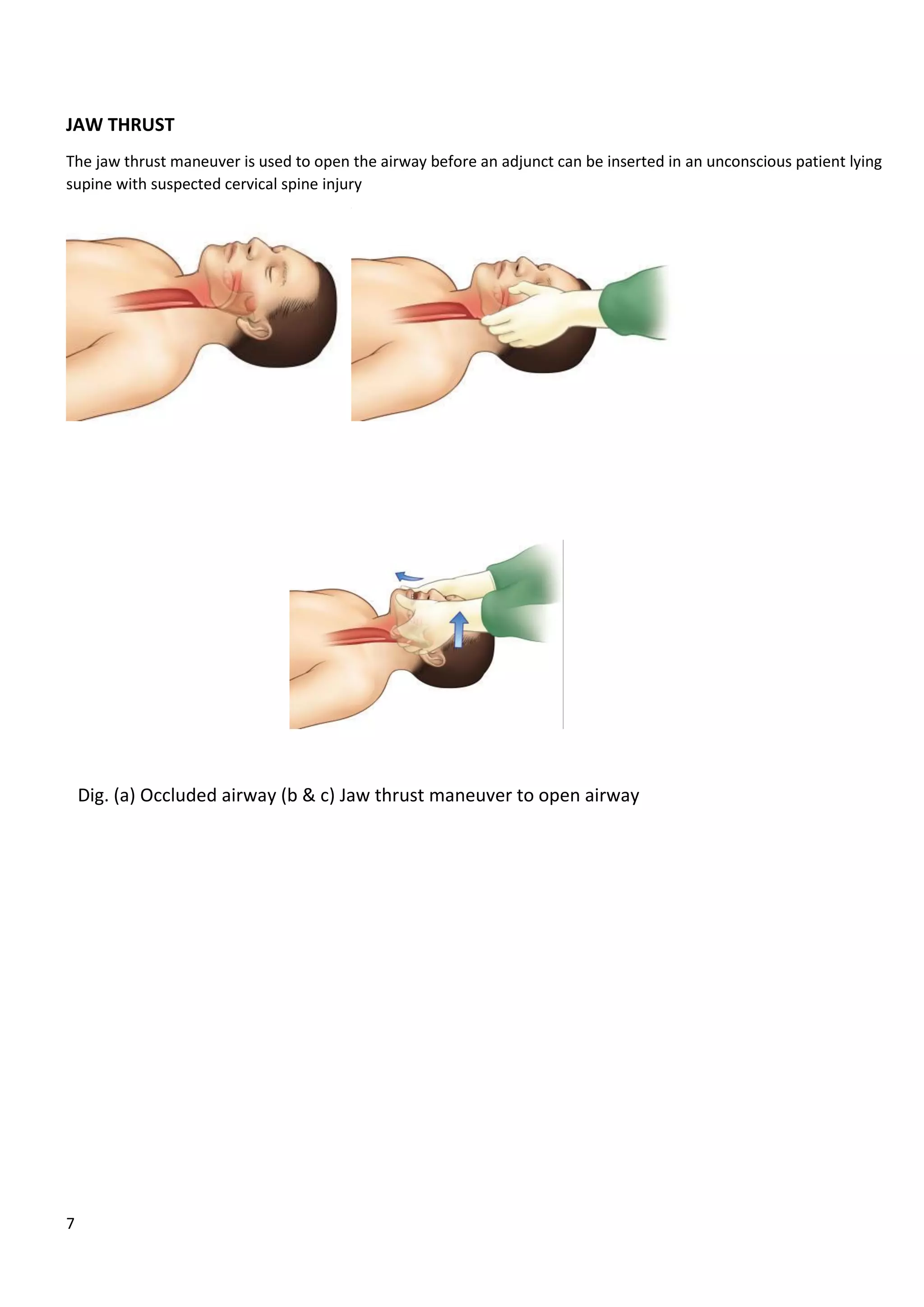 Guideline for airway management3 | PDF