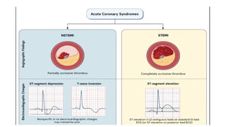 Masked Stemi Guidelines for Managing Acute Coronary Syndromes: NSTEMI and STEMI ...