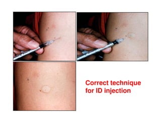 Infiltration Injection Rabies Guideline_Rabies_prophylaxis_PPT_PDF.pdf