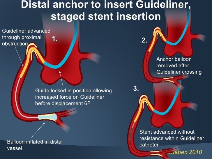 Guideliner vascular solutions