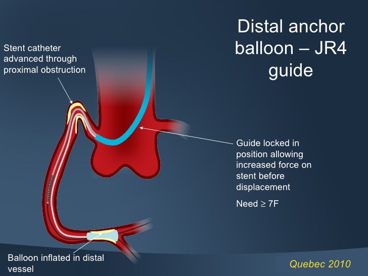guideliner catheter ppt guideliner catheter ppt