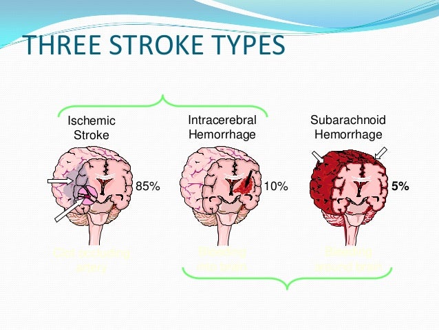 Guidelines For Management Of Acute Stroke Guidelines For Management Of Acute Stroke