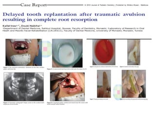 Tooth Avulsion Project Guidelines for the management of traumatic dental injuries.ii.avulsion ...