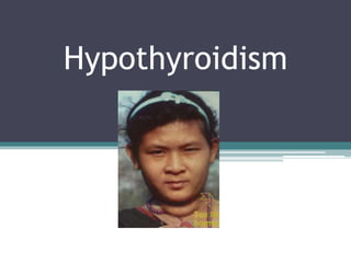 Hypothyroidism
 