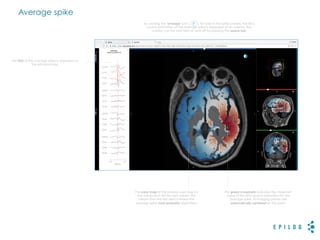 Average spike
The EEG of the average spike is displayed on
the left-hand side.
The color map of the overlay uses blue for
low values and red for high values. This
means that the red area is where the
average spike most probably originated.
By clicking the 'average' icon ( ) for one of the spike clusters, the EEG
source estimation of the average spike is displayed as an overlay. The
overlay can be switched on and off by pressing the space bar.
The green crossmark indicates the maximum
value of the EEG source estimation for the
average spike. All imaging planes are
automatically centered on this point.
 