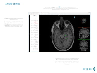 Single spikes
The EEG of the single spike is displayed on
the left-hand side.
By clicking this panel, the EEG of the next
single spike will be shown in the panel. The
viewing planes will also automatically be
centered on the maximum point of EEG
source estimation for that single spike.
By clicking the 'singles' icon ( ) for one of the spike clusters, the
maximum points of the EEG source estimation of the 10 single spikes with the
highest similarity to the average spike.
The maximum points of the EEG source estimation of
all 10 single spikes are shown as green diamonds.
The viewing planes are automatically centered on
the maximum point of the single spike shown in the
EEG panel.
 