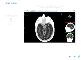 Head model
From white to black, the 6 different
discriminated tissue types are shown:
n Scalp
n Skull
n CSF
n White matter
n Grey matter
n Air
By clicking the 'head model' icon ( ) in the EEG panel, the patient-
specific head model is displayed. This head model discriminates 6 tissue
types and is used to perform EEG source estimation.
 