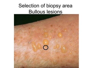 Bullous Rash Pathology Guide on skin biopsy. Mikhail Valivach | PPT