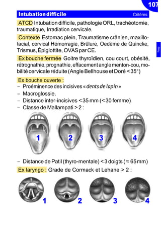 107
ATCD Intubationdifficile,pathologieORL,trachéotomie,
traumatique, Irradiation cervicale.
Contexte Estomac plein, Traumatisme crânien, maxillo-
facial, cervical Hémorragie, Brûlure, Oedème de Quincke,
Trismus,Épiglottite, OVASparCE.
Ex bouche fermée Goitre thyroïdien, cou court, obésité,
rétrognathie,prognathie,effacementanglementon-cou,mo-
bilitécervicaleréduite(AngleBellhouseetDoré<35°)
Ex bouche ouverte :
Ŕ Proéminence desincisives «dentsdelapin»
Ŕ Macroglossie.
Ŕ Distance inter-incisives < 35 mm (< 30 femme)
Ŕ Classe de Mallampati > 2 :
Ŕ Distance de Patil (thyro-mentale) < 3 doigts (≈65mm)
Ex laryngo : Grade de Cormack et Lehane > 2 :
1 2 3 4
Intubationdifficile Critères
1 2 3 4
Resp
 