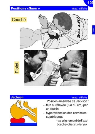 109
⇒
Position amendée de Jackson :
Ŕ tête surélevée (6 à 10 cm) par
uncousin.
Ŕ hyperextension des cervicales
supérieures
= alignement del’axe
boucheŔpharynxŔlarynx
Positions «Smur» Intub. difficile
Couché
Jackson Intub. difficile
Piolet
Resp
 