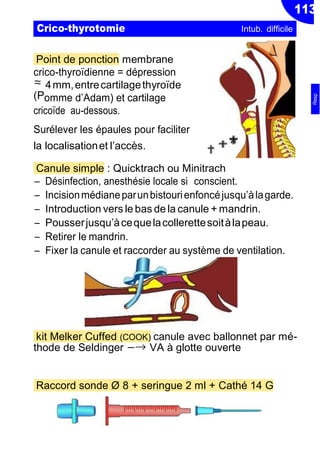 113
≈
(P
Point de ponction membrane
crico-thyroïdienne = dépression
4mm,entrecartilagethyroïde
omme d’Adam) et cartilage
cricoïde au-dessous.
Surélever les épaules pour faciliter
la localisationet l’accès. ✟
Canule simple : Quicktrach ou Minitrach
Ŕ Désinfection, anesthésie locale si conscient.
Ŕ Incisionmédianeparunbistourienfoncéjusqu’àlagarde.
Ŕ Introduction vers le bas de la canule + mandrin.
Ŕ Pousserjusqu’àcequelacollerettesoitàlapeau.
Ŕ Retirer le mandrin.
Ŕ Fixer la canule et raccorder au système de ventilation.
kit Melker Cuffed (COOK) canule avec ballonnet par mé-
thode de Seldinger −→ VA à glotte ouverte
Raccord sonde Ø 8 + seringue 2 ml + Cathé 14 G
Crico-thyrotomie Intub. difficile
✟✟✯
Resp
 