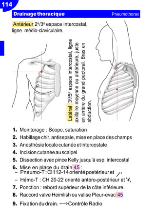 114
/'
Resp
Antérieur 2e/3e espace intercostal,
ligne médio-claviculaire.
1. Monitorage : Scope, saturation
2. Habillagechir,antisepsie,miseenplace deschamps
3. Anesthésielocalecutanéeetintercostale
4. Incisioncutanéeauscalpel
5. Dissection avec pince Kelly jusqu’à esp. intercostal
6. Mise en place du drain 45 :
Ŕ Pneumo-T:CH12-14orientépostérieuret
Ŕ Hémo-T : CH 20-22 orienté antéro-postérieur et',
7. Ponction : rebord supérieur de la côte inférieure.
8. Raccord valve Heimlish ou valise Pleur-evac 45
9. Fixationdudrain.−→ContrôleRadio
Drainagethoracique Pneumothorax
Latéral3e/5eespaceintercostal,ligne
axillairemoyenneouantérieure,juste
enarrièredugrandpectoral.Brasen
abduction.
 