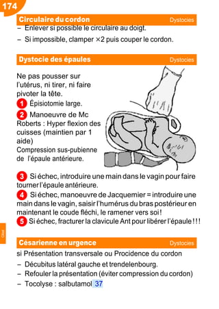 174
1
2
3
4
5
Ŕ Enlever si possible le circulaire au doigt.
Ŕ Si impossible, clamper ×2 puis couper le cordon.
Ne pas pousser sur
l’utérus, ni tirer, ni faire
pivoter la tête.
Épisiotomie large.
Manoeuvre de Mc
Roberts : Hyper flexion des
cuisses (maintien par 1
aide)
Compression sus-pubienne
de l’épaule antérieure.
Si échec, introduire une main dans le vagin pour faire
tournerl’épaule antérieure.
Si échec,manoeuvre de Jacquemier =introduire une
main dans le vagin, saisir l’humérus du bras postérieur en
maintenant le coude fléchi, le ramener vers soi!
Si échec, fracturer la clavicule Ant pour libérer l’épaule!!!
si Présentation transversale ou Procidence du cordon
Ŕ Décubitus latéral gauche et trendelenbourg.
Ŕ Refouler la présentation (éviter compression du cordon)
Ŕ Tocolyse : salbutamol 37
Circulaireducordon Dystocies
Dystocie des épaules Dystocies
Césarienne en urgence Dystocies
Obst
 