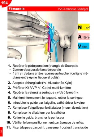 194
Perf
N erf
A rtère
Veine
1. Repérerleptdeponction(triangledeScarpa):
Ŕ 2cmen-dessousdel’arcadecrurale
Ŕ 1cm en dedans artère repérée au toucher (ou ligne mé-
diane entre épine iliaque et pubis)
2. Asepsiechirurgicale(+/−ALcutanéeXylo)
3. Préférer Kit VVP +/− Cathé multi-lumière
4. Repérerlaveineàlaseringue«videàlamain»
5. Maintenir fermement le toquard, retirer la seringue
6. Introduire le guide par l’aiguille, cathétériser la veine
7. Remplacer l’aiguille par le dilatateur (mouv. de rotation)
8. Remplacer le dilatateur par lecathéter
9. Retirer le guide, brancher le perfuseur
10. Vérifier le bon positionnement par épreuve de reflux
11. Fixeràlapeauparpoint, pansement occlusif translucide
Fémorale VVCTechnique Seldinger
 