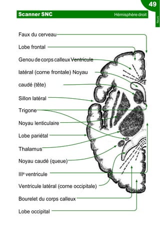 Faux du cerveau
Lobe frontal
Genou decorpscalleuxVentricule
latéral (corne frontale) Noyau
caudé (tête)
Sillon latéral
Trigone
Noyau lenticulaire
Lobe pariétal
Thalamus
Noyau caudé (queue)
IIIe ventricule
Ventricule latéral (corne occipitale)
Bourelet du corps calleux
Lobe occipital
49
Scanner SNC Hémisphère droit
Neuro
 