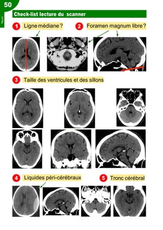 2
5
50
Check-list lecture du scanner
1 Ligne médiane? Foramen magnum libre?
Taille des ventricules et des sillons
Liquides péri-cérébraux Tronc cérébral
3
4
Neuro
 