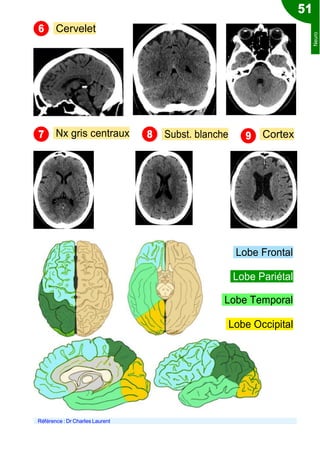 Cervelet
Nx gris centraux Subst. blanche Cortex
Lobe Frontal
Lobe Pariétal
Lobe Temporal
Lobe Occipital
Référence : Dr Charles Laurent
51
6
7 8 9
Neuro
 