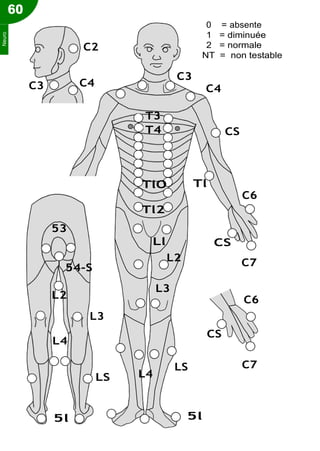 60
C2
C3 C4
0 = absente
1 = diminuée
2 = normale
NT = non testable
C3
C4
T3
T4 CS
53
54-S
L2
L3
TlO Tl
C6
Tl2
Ll CS
L2 C7
L3
C6
L4
CS
L4
LS C7
LS
5l 5l
Neuro
 