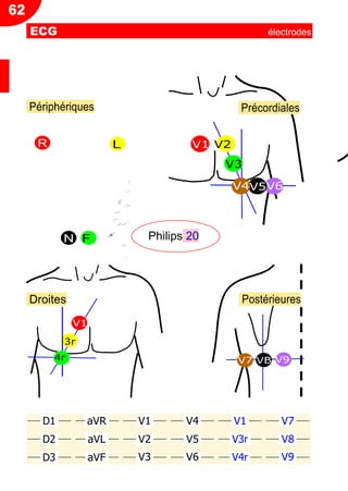 CV
Postérieures
V7 VB V9
Droites
V1
3r
4r
Périphériques Précordiales
R L V1 V2
V3
V4V5V6
N F Philips 20
V1
V2
V3
V4
V5
V6
V1
V3r
V4r
V7
V8
V9
D1 aVR
D2 aVL
D3 aVF
62
ECG électrodes
 