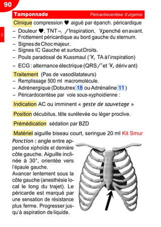 90
− /' ',
Clinique compression ♥ aiguë par épanch. péricardique
Ŕ Douleur ♥, TNT , inspiration, penché enavant.
Ŕ Frottement péricardique au bord gauche du sternum.
Ŕ SignesdeChocmajeur.
Ŕ Signes IC Gauche et surtoutDroits.
Ŕ Pouls paradoxal de Kussmaul (', TA àl’inspiration)
Ŕ ECG : alternance électrique (QRS /' et ', dériv ant)
Traitement (Pas de vasodilatateurs)
Ŕ Remplissage 500 ml macromolécule.
Ŕ Adrénergique (Dobutrex 18 ou Adrénaline 11)
Ŕ Péricardocentèse par voie sous-xyphoidienne :
Indication AC ou imminent « geste de sauvetage »
Position décubitus, tête surélevée ou léger proclive.
Prémédication sédation par BZD
Matériel aiguille biseau court, seringue 20 ml Kit Smur
Ponction : angle entre ap-
pendice xiphoïde et dernière
côte gauche. Aiguille incli-
née à 30°, orientée vers
l’épaule gauche.
Avancer lentement sous la
côte gauche (anesthésie lo-
cal le long du trajet). Le
péricarde est marqué par
une sensation de résistance
plus ferme. Progresser jus-
qu’à aspiration de liquide.
Tamponnade Péricardiocentèse d’urgence
CV
 