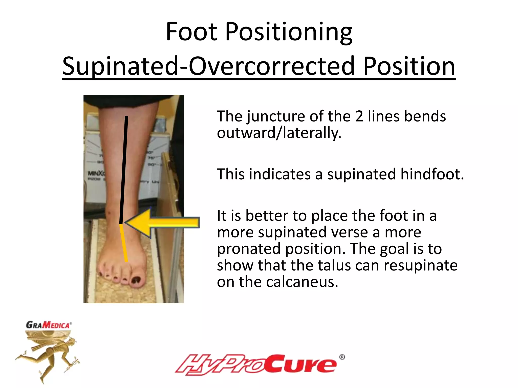 Foot Positioning
Supinated-Overcorrected Position
The juncture of the 2 lines bends
outward/laterally.
This indicates a supinated hindfoot.
It is better to place the foot in a
more supinated verse a more
pronated position. The goal is to
show that the talus can resupinate
on the calcaneus.
 