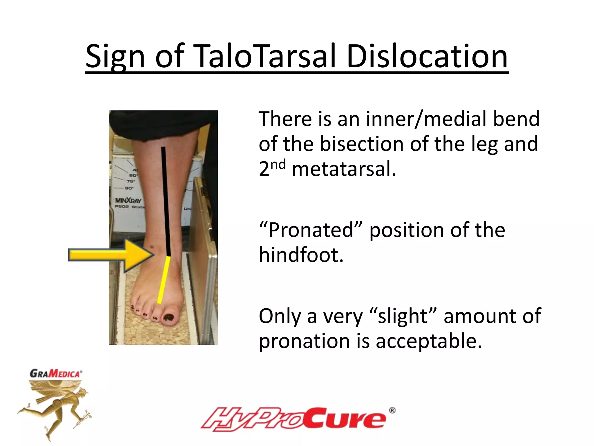 Sign of TaloTarsal Dislocation
There is an inner/medial bend
of the bisection of the leg and
2nd metatarsal.
“Pronated” position of the
hindfoot.
Only a very “slight” amount of
pronation is acceptable.
 