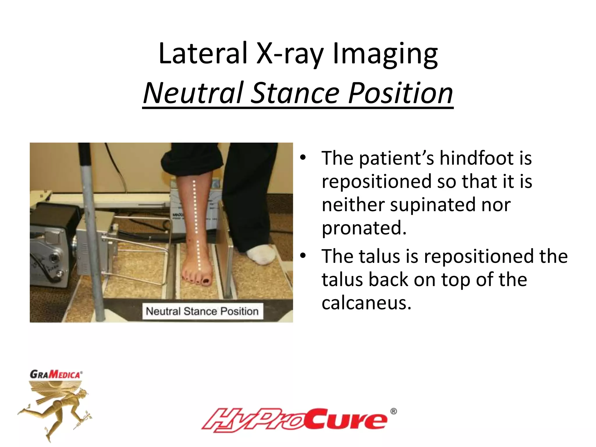 Lateral X-ray Imaging
Neutral Stance Position
• The patient’s hindfoot is
repositioned so that it is
neither supinated nor
pronated.
• The talus is repositioned the
talus back on top of the
calcaneus.
 