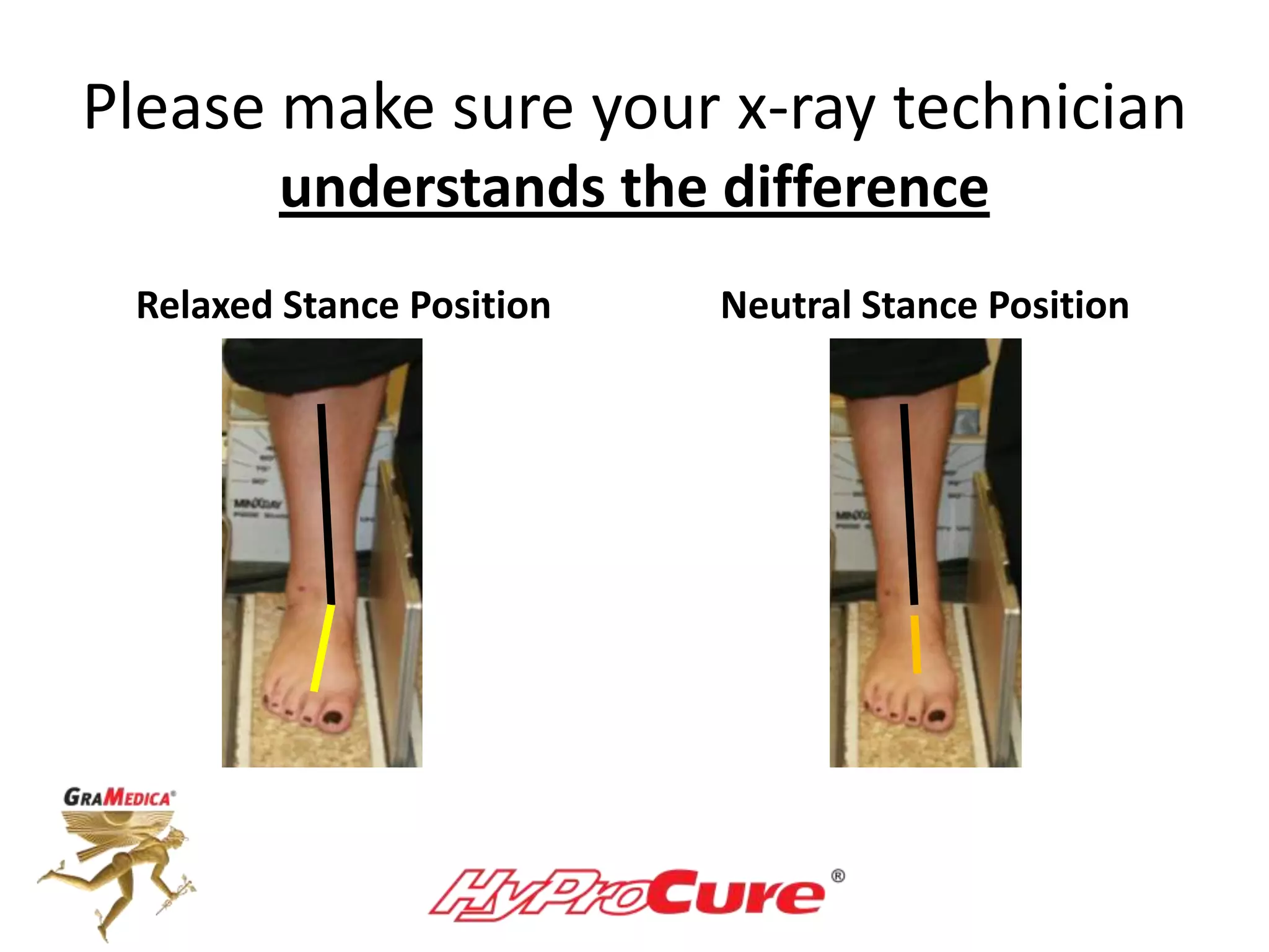 Please make sure your x-ray technician
understands the difference
Relaxed Stance Position Neutral Stance Position
 