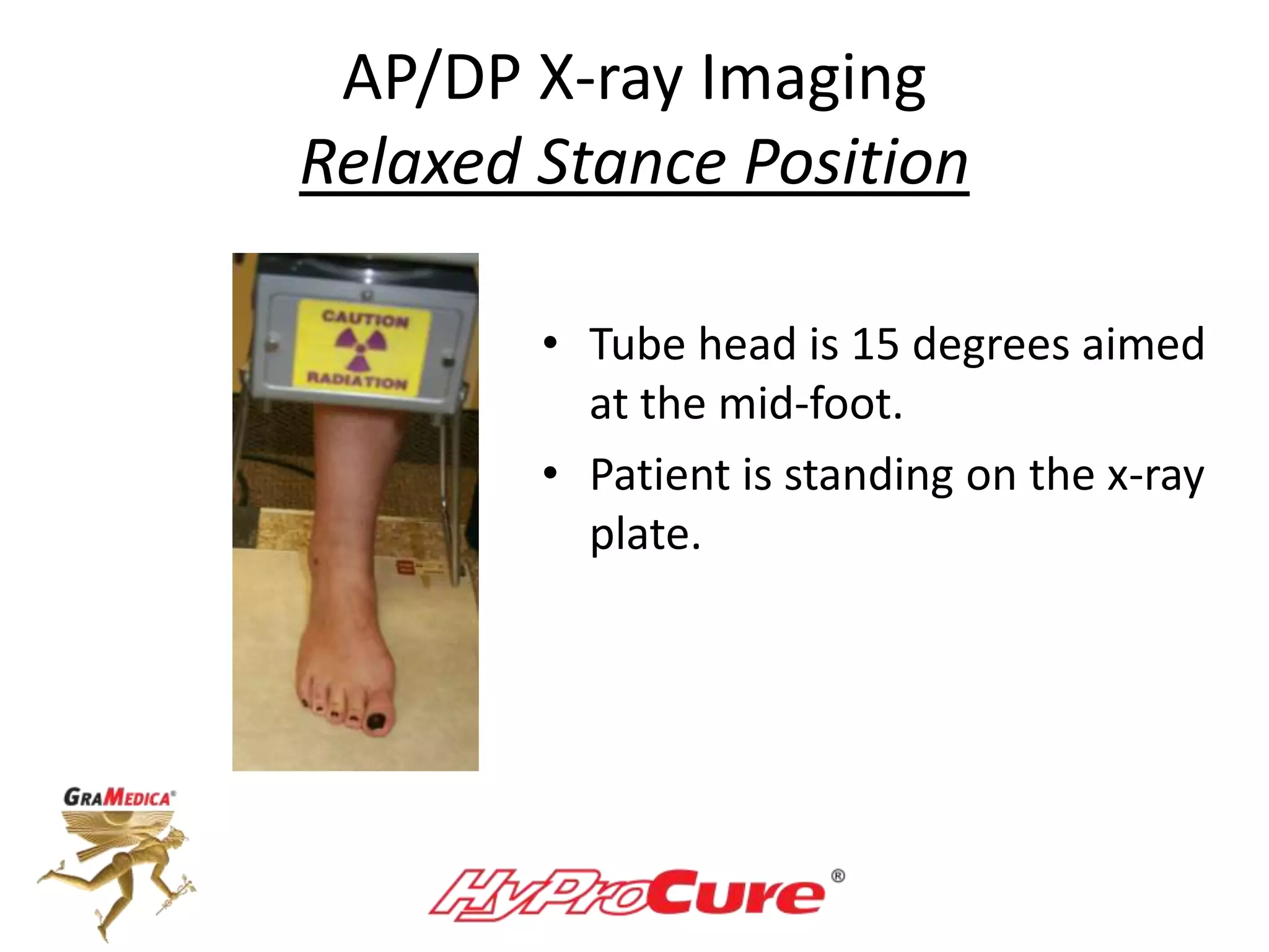 AP/DP X-ray Imaging
Relaxed Stance Position
• Tube head is 15 degrees aimed
at the mid-foot.
• Patient is standing on the x-ray
plate.
 